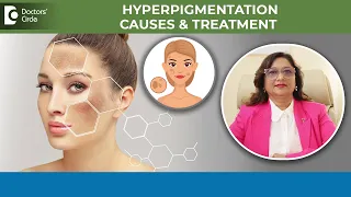 PIGMENTATION or DARK SPOTS on Face- Causes | Hyperpigmentation Cure - Dr Minu Jain | Doctors' Circle