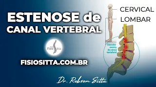 ESTENOSE de CANAL VERTEBRAL COLUNA LOMBAR EXAME SINAIS e SINTOMAS Fisioterapia Dr. Robson Sitta