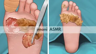 ASMR Satisfying foot wart treatment | screw nail removal | tingle sound | imani ASMR