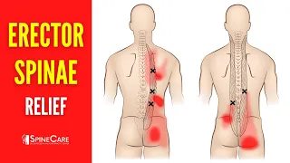 How to Fix Erector Spinae Pain FOR GOOD