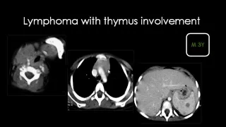 Imaging of Pediatric chest part 3 Mediastinum    Dr Mamdouh Mahfouz