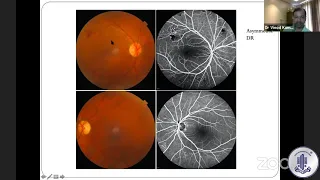 Walk in Retina Patient in your OPD: Diabetic Retinopathy Inchmeal Slayer by Dr Vinod Kumar