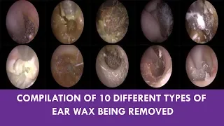 COMPILATION OF 10 DIFFERENT TYPES OF EAR WAX BEING REMOVED - #482