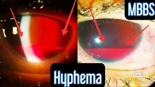 Injury to the eye- Hyphema #medicine #mbbs #neetpg #usmle #inicet #neet #aiims #ophthalmology