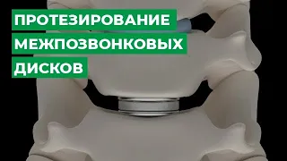 Протезирование межпозвонковых дисков