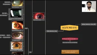 Acute Red Eye - Master the Differential Diagnoses with Mind Map