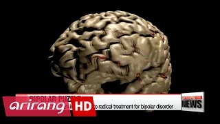 Korean researchers inch closer to radical treatment for bipolar disorder