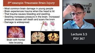 367 Lecture 3.5 Diseases of the Brain