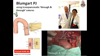 Pylorus Resecting Pancreaticoduodenectomy & Blumgart's Duct-to-mucosa Pancreaticojejunostomy(DMPJ)