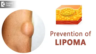 Prevent Lipomas From Occurring | Fatty Lump | Fatty Tumor - Dr. Sahebgowda Shetty | Doctors' Circle