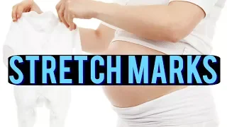 Stretch mark prevention: pregnancy| Q&A with Dr Dray 👶💪