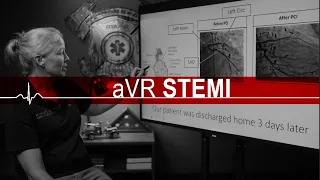 ST Elevation in aVR