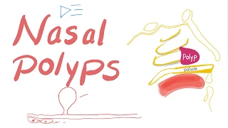 Nasal Polyps (Allergic Rhinitis and Cystic Fibrosis)