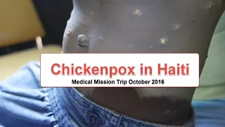 Chickenpox or Varicella in Haiti