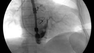 Coronary sinus catheter Fluoroscopy Correct placement