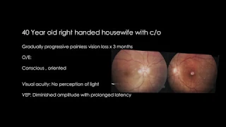 Endoscopic Optic Nerve Decompression