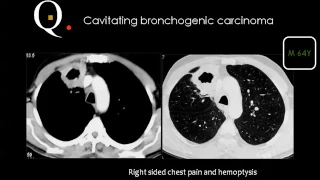 Chest Quiz Prof.Dr. Mamdouh Mahfouz