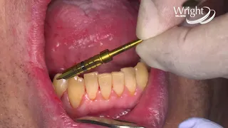 Wright Millners   Dr Bradley Bredekamp   Megagen Anyridge implant placement