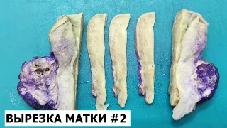 Вырезка матки #2 - рак эндометрия