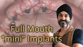 Full Set of Dental Implants, with Mini Implants, 1/2 the cost of All on 4