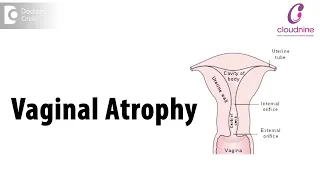 What is Vaginal Atrophy? Can Vaginal Atrophy be reversed?- Dr. Vibha Arora of Cloudnine Hospitals