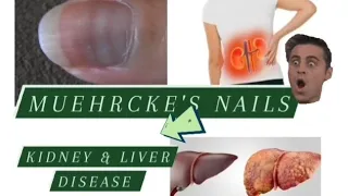 WHITE LINES IN NAILS ( MUEHRCKE'S NAILS) Linked with kidney & liver disease