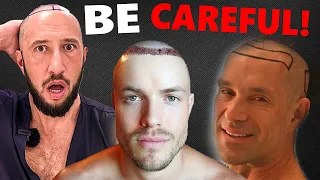 4 CONS of 3.000$ Hair Transplant in Turkey!!! (Low Cost)