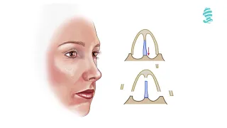 Rhinoplasty: Detailed animation about the operation