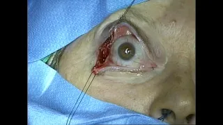 Lateral canthotomy incision for access to lateral orbit