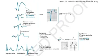 ST elevation on ECG, part 1: Differential diagnosis and case studies- STEMI mimickers, subtle STEMI