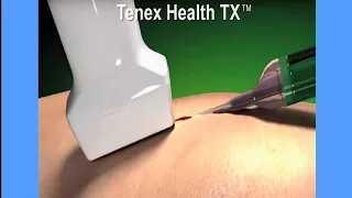 How It Works - Tenex Health TX