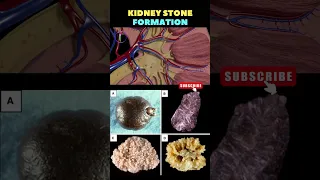 Kidney Stone formation Animation | Kidney stone removal | Kidney disease