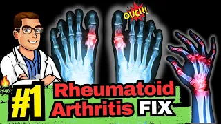 The #1 New Rheumatoid Arthritis Treatments!