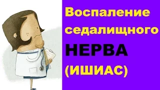 Воспаление седалищного нерва (ишиас): симптомы и лечение