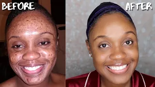 AFFORDABLE SKIN CARE ROUTINE FOR ACNE, DARK MARKS, AND HYPERPIGMENTATION