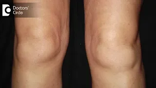 What are the causes of swelling in knees? - Dr.Nagesh HS