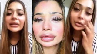 Sara Khan Reaction On Her Lip Job Surgery GONE WRONG