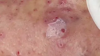 Best Pimple Popping P1 ｜ Mụn Dậy Thì Siêu Hấp Dẫn P1   SacDepSpa#181 3