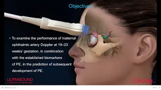 New #UOGJournal video abstract on Ophthalmic artery Doppler in the prediction of pre-eclampsia