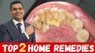Top 2 Remedies To Remove Dental Plaque | Remove Dental Plaque and keep Oral Hygiene Healthy At Home
