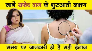 |Early Signs & Symptoms of  Vitiligo | Dr Nitika Kohli |
