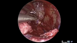 Endoscopic endonasal resection of giant pediatric craniopharyngioma: impact on hypothalamic edema