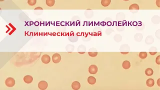 Хронический лимфолейкоз. Клинический случай