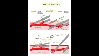 Venipuncture - How to Position a Needle