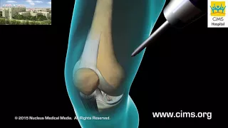 Knee Arthroscopy  (Hindi) - CIMS Hospital