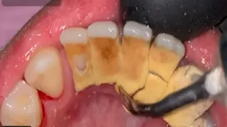 تنظيف جير الاسنان