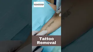 😨LIVE Tattoo Removal #shorts #shortsfeed