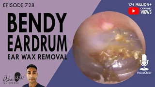 728 - Bendy Eardrum Ear Wax Removal