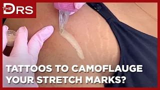Could Tattoos Be the Answer to Your Stretch Marks?