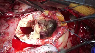 Aneurysmectomy and graft interposition of the transverse aortic arch and ascending aorta